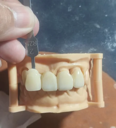 A3 Tooth Shade Bridge Case from an Indonesian Dental Lab Featured Image