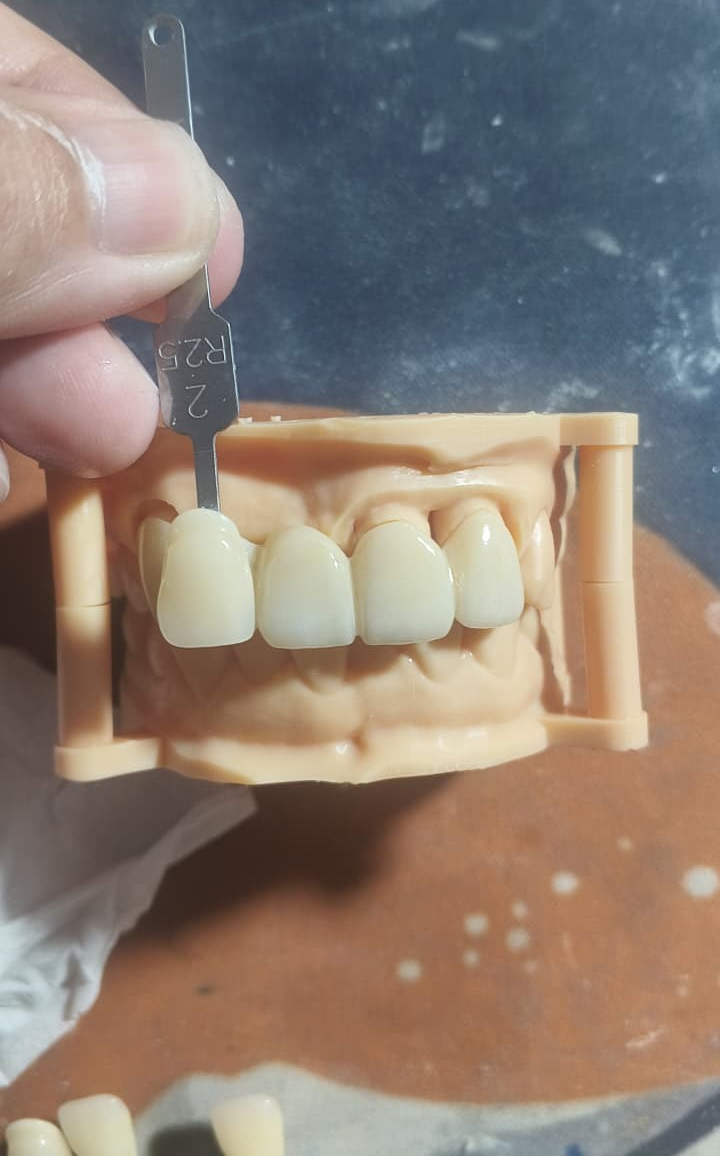 A3 dental shade bridge on model with 2R2.5 reference tab