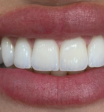 Clinical-side veneer case showing BL1 tooth shade in the mouth