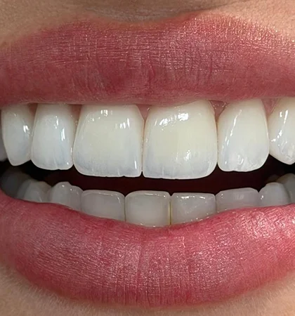 Clinical-side close-up of BL1 veneer shade from the same case