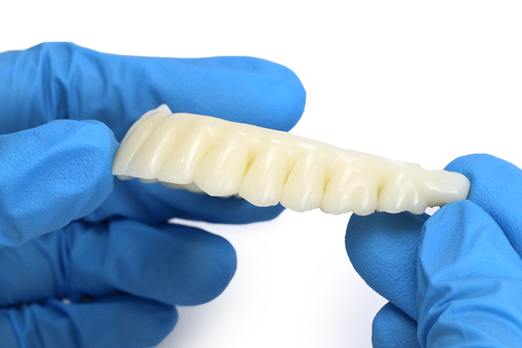 3D printed permanent crown and bridge restoration made with ceramic-filled resin