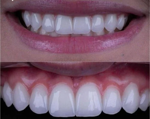 BL1 Anterior Zirconia Case from a Moroccan Dental Lab Featured Image