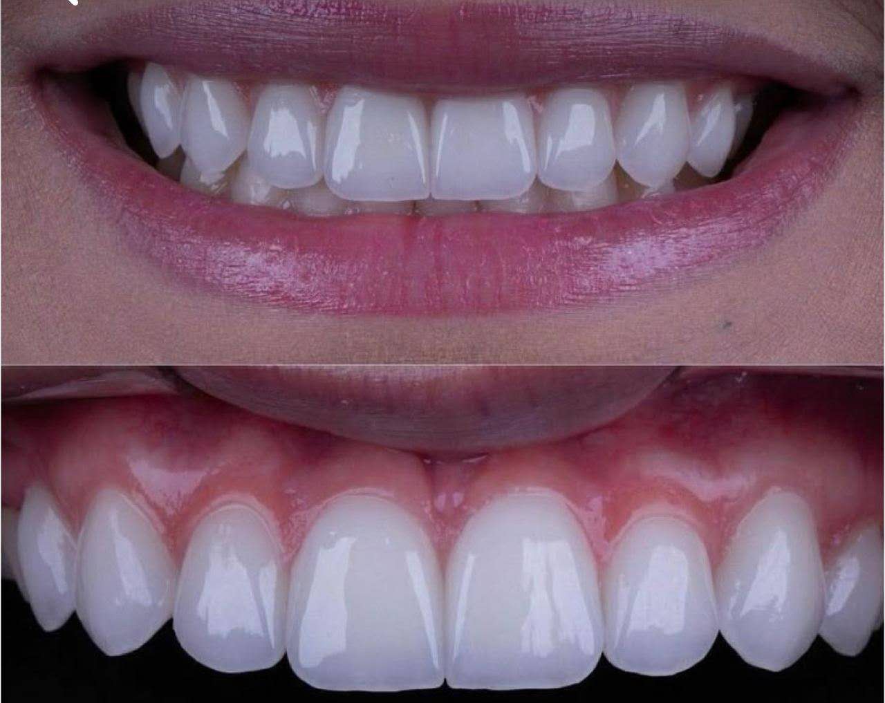 Final intraoral result of a BL1 zirconia anterior restoration